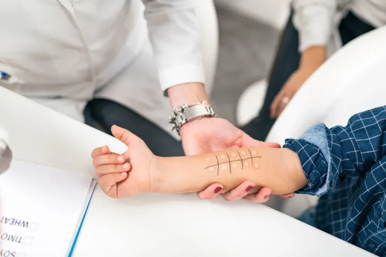Can I Eat Before An Allergy Test?